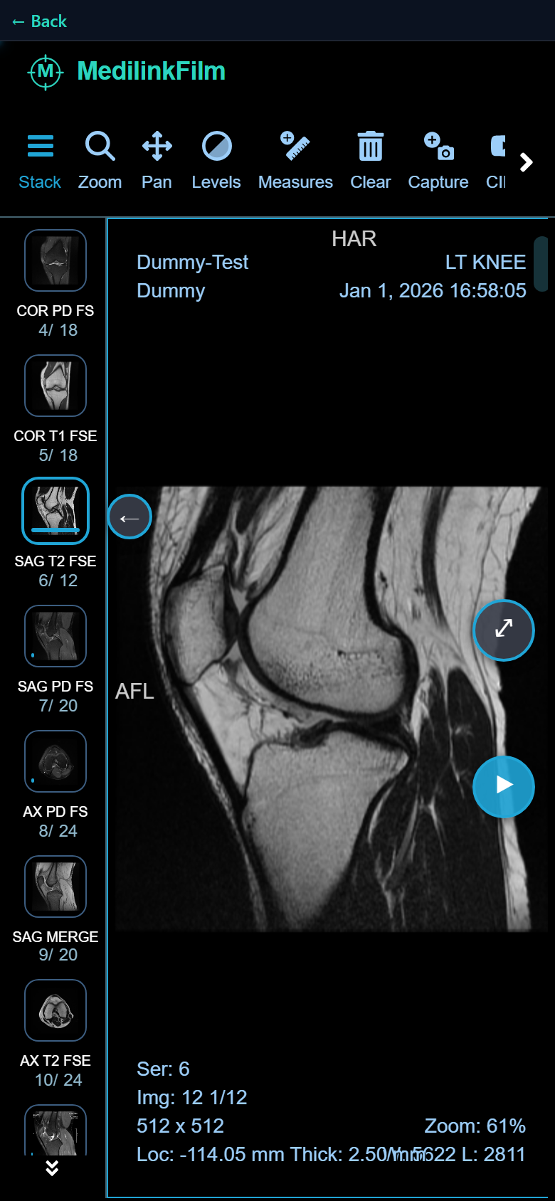 MediLinkFilm DICOM viewer on phone — SAG T2 FSE knee MRI